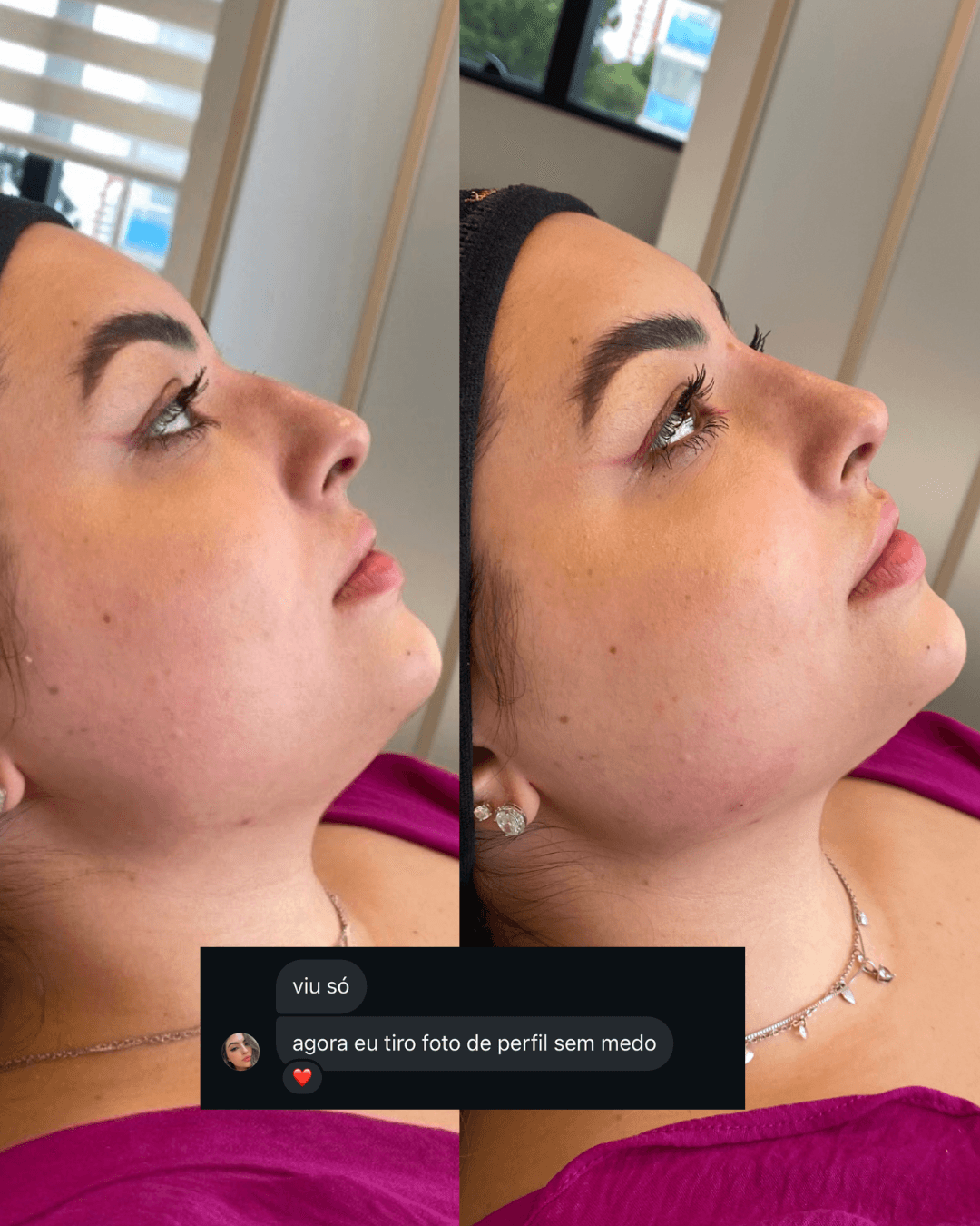 Antes e depois — Rinomodelação + Preenchimento de Mandíbula