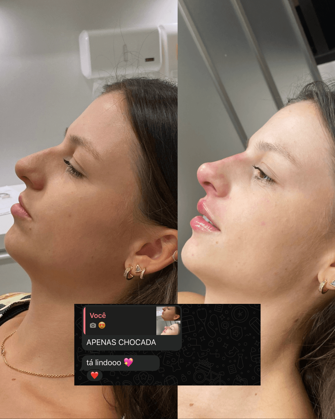 Antes e depois — Rinomodelação + Preenchimento Labial