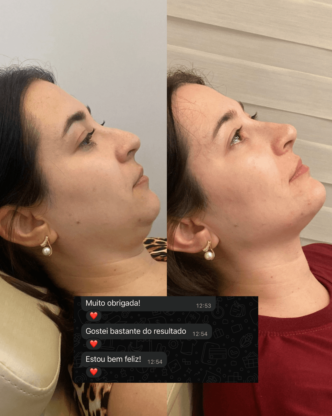Antes e depois — Protocolo PERFIL4D®