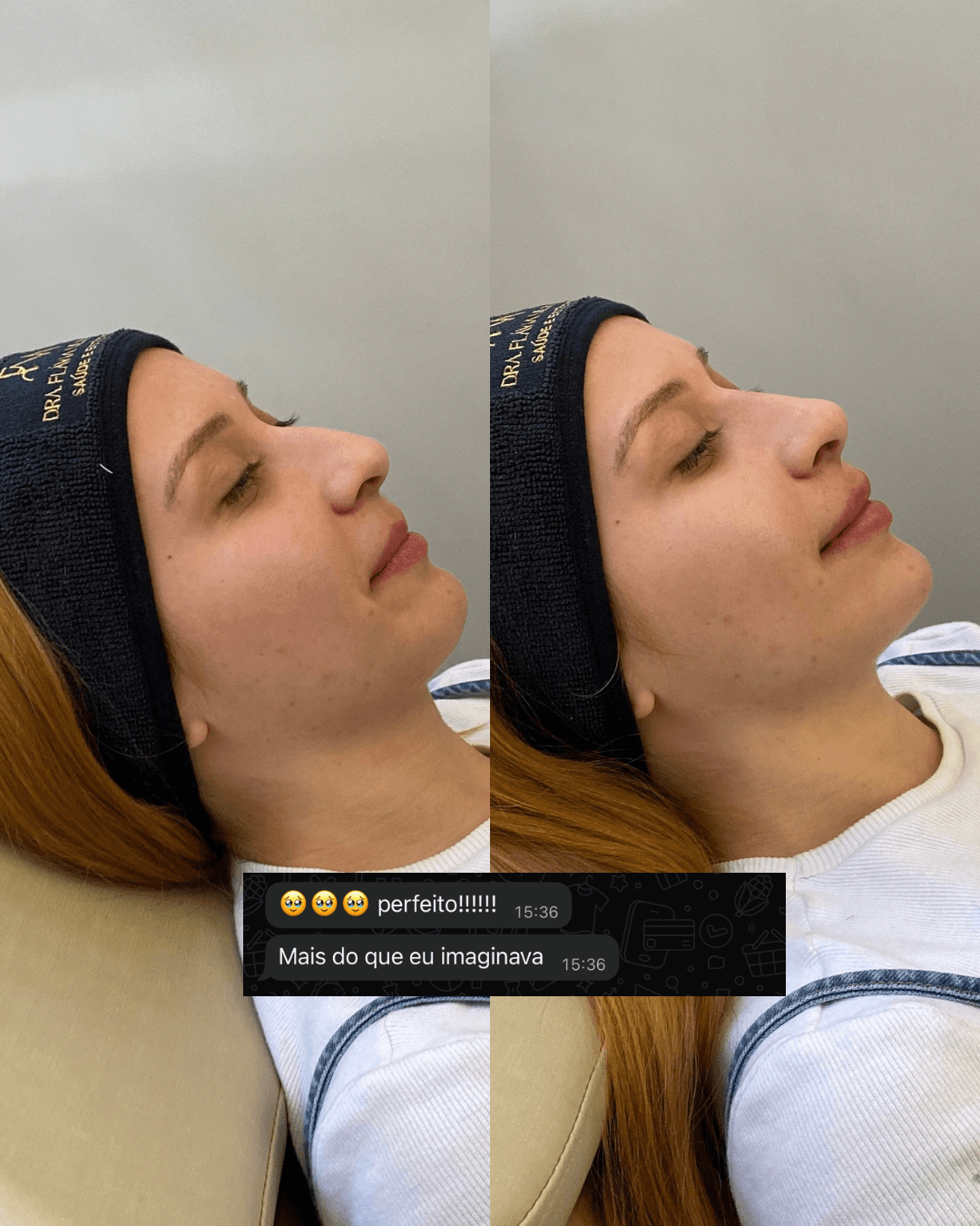 Antes e depois — Rinomodelação, Preenchimento Labial e Mento