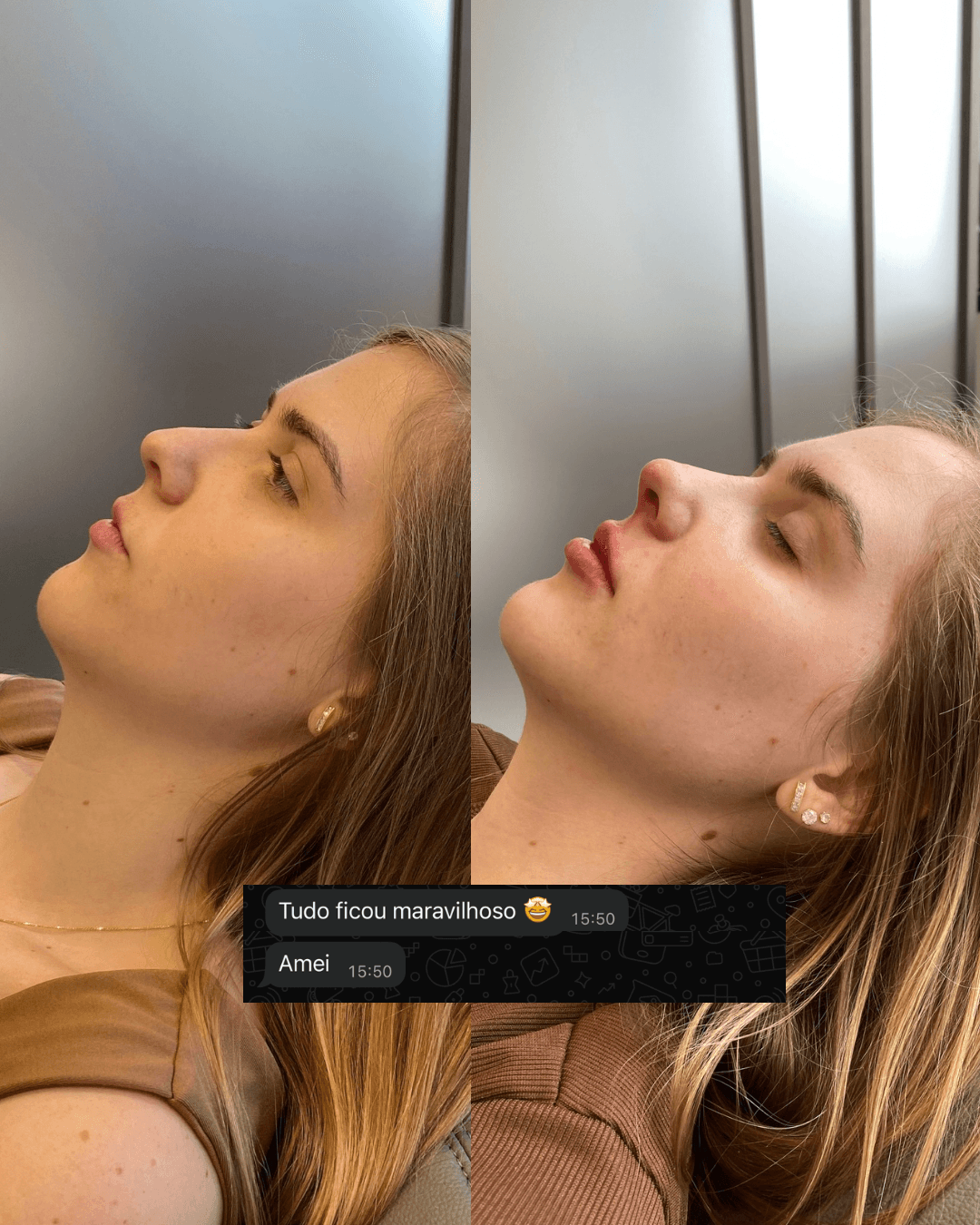 Antes e depois — Rinomodelação + Harmonização Facial